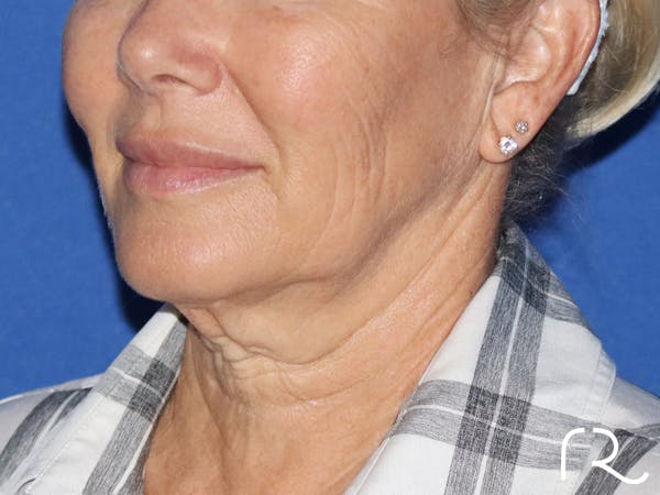 Neck Lift Before & After Gallery - Patient 116245932 - Image 1