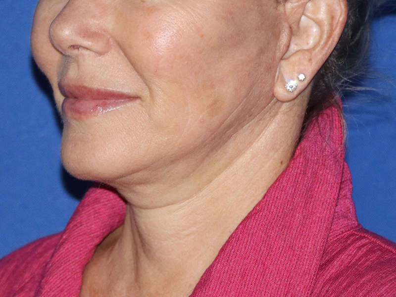 Neck Lift Before & After Gallery - Patient 116245932 - Image 2