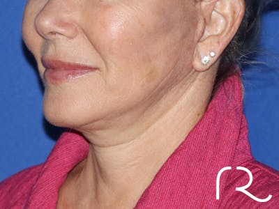 Facelift Before & After Gallery - Patient 116246271 - Image 2