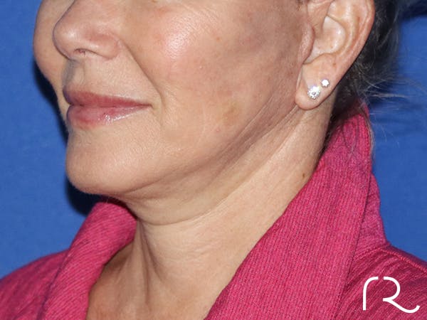 Neck Lift Before & After Gallery - Patient 116245932 - Image 2