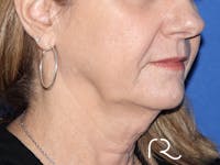 Neck Lift Before & After Gallery - Patient 116245933 - Image 1