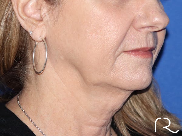 Facelift Before & After Gallery - Patient 116246272 - Image 1