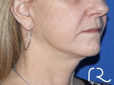 Facelift Before & After Gallery - Patient 116246272 - Image 2