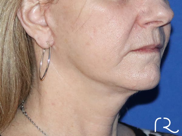 Neck Lift Before & After Gallery - Patient 116245933 - Image 2