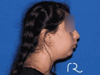 Chin Augmentation  Before & After Gallery - Patient 116247910 - Image 1