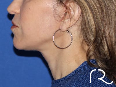 Facelift Before & After Gallery - Patient 116251797 - Image 4