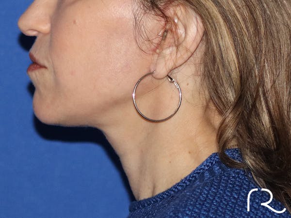 Neck Lift Before & After Gallery - Patient 116251902 - Image 4