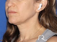 Facelift Before & After Gallery - Patient 116251797 - Image 1