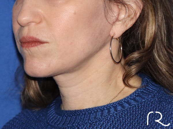 Neck Lift Before & After Gallery - Patient 116251902 - Image 2