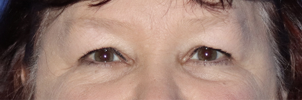 Eyelid Surgery Before & After Gallery - Patient 120181816 - Image 1