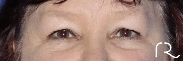 Eyelid Surgery Gallery - Patient 120181816 - Image 1