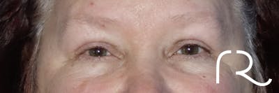 Eyelid Surgery Before & After Gallery - Patient 120181816 - Image 2