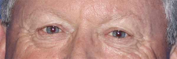 Eyelid Surgery Before & After Gallery - Patient 121955871 - Image 1