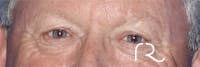 Eyelid Surgery Gallery - Patient 121955871 - Image 1