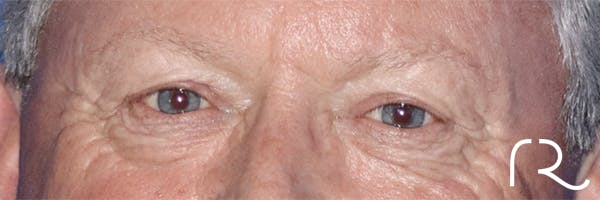Eyelid Surgery Before & After Gallery - Patient 121955871 - Image 1