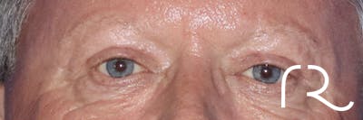 Eyelid Surgery Gallery - Patient 121955871 - Image 2