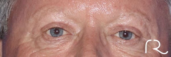 Eyelid Surgery Before & After Gallery - Patient 121955871 - Image 2