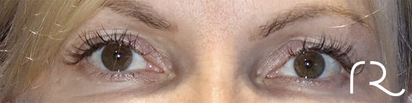 Eyelid Surgery Before & After Gallery - Patient 121955872 - Image 1