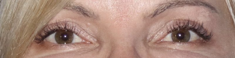 Eyelid Surgery Before & After Gallery - Patient 121955872 - Image 2