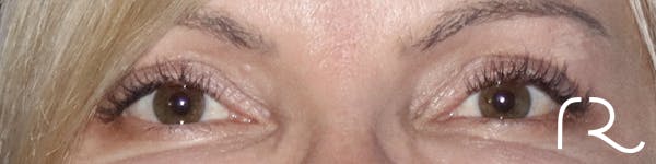 Eyelid Surgery Before & After Gallery - Patient 121955872 - Image 2