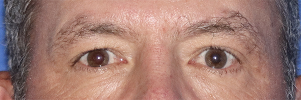 Eyelid Surgery Before & After Gallery - Patient 121955873 - Image 1