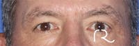 Eyelid Surgery Gallery - Patient 121955873 - Image 1