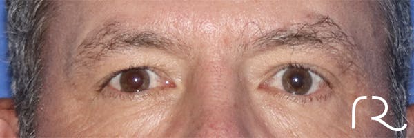 Eyelid Surgery Before & After Gallery - Patient 121955873 - Image 1