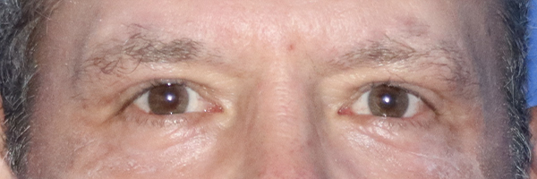 Eyelid Surgery Before & After Gallery - Patient 121955873 - Image 2