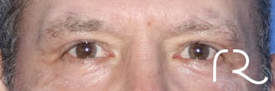 Eyelid Surgery Before & After Gallery - Patient 121955873 - Image 2