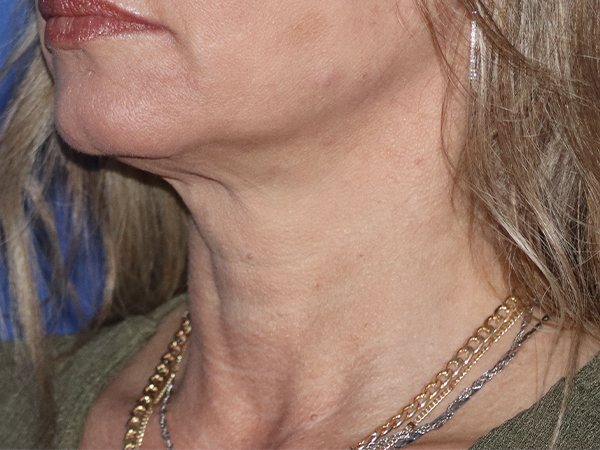 Neck Lift Before & After Gallery - Patient 121956049 - Image 1