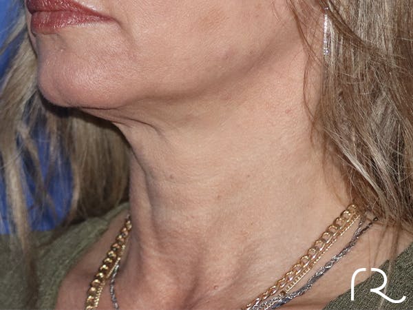 Neck Lift Before & After Gallery - Patient 121956049 - Image 1