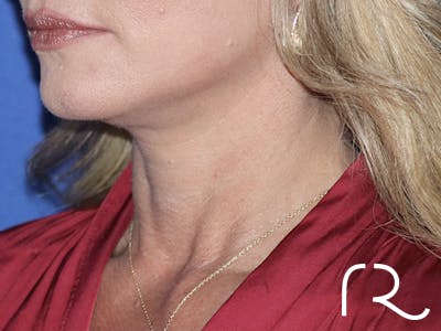Facelift Before & After Gallery - Patient 121956017 - Image 2