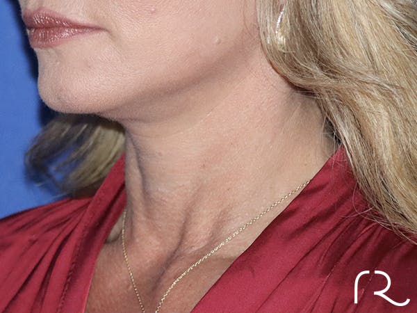 Neck Lift Before & After Gallery - Patient 121956049 - Image 2