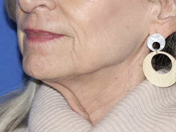 Neck Lift Before & After Gallery - Patient 121956050 - Image 1