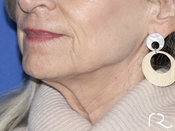 Neck Lift Before & After Gallery - Patient 121956050 - Image 1