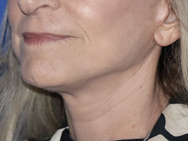 Neck Lift Before & After Gallery - Patient 121956050 - Image 2