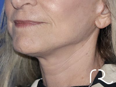 Facelift Before & After Gallery - Patient 121956018 - Image 2