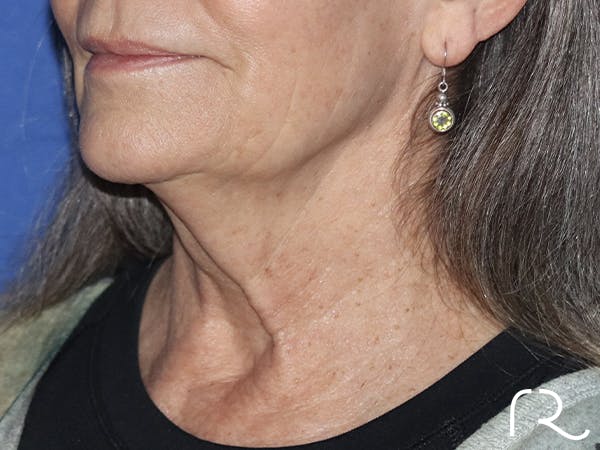 Neck Lift Before & After Gallery - Patient 121956051 - Image 1