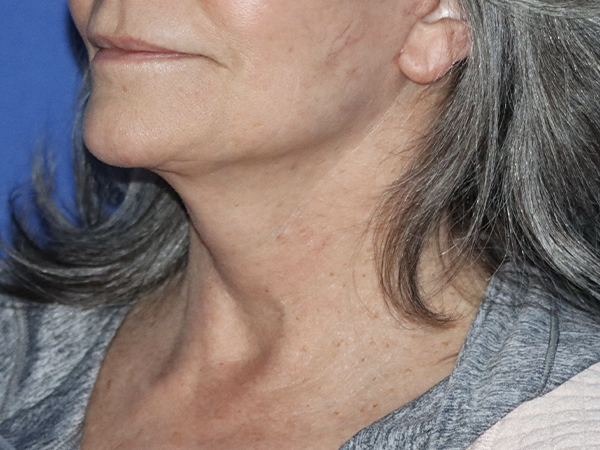 Facelift Before & After Gallery - Patient 121956019 - Image 2