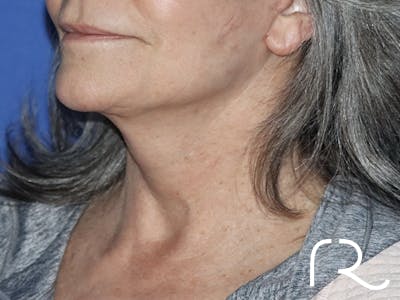 Facelift Before & After Gallery - Patient 121956019 - Image 2