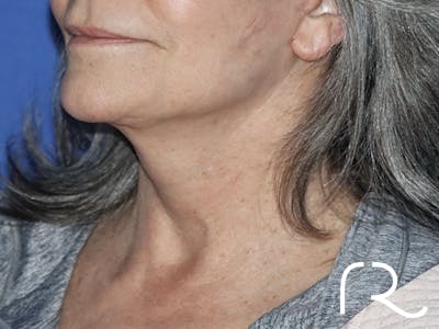Neck Lift Before & After Gallery - Patient 121956051 - Image 2