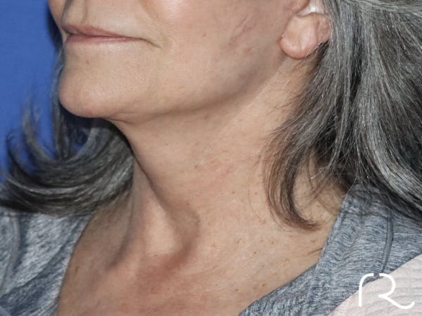 Neck Lift Before & After Gallery - Patient 121956051 - Image 2