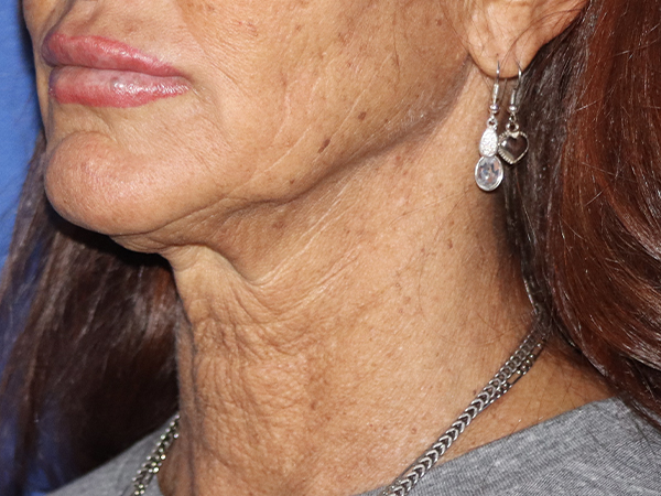 Neck Lift Before & After Gallery - Patient 121956052 - Image 1