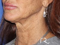 Neck Lift Before & After Gallery - Patient 121956052 - Image 1