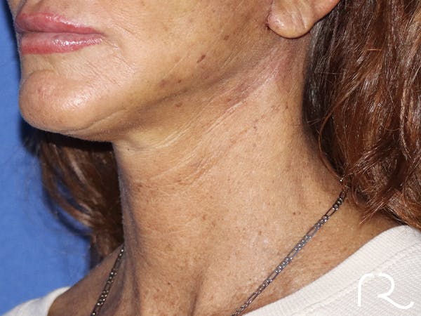 Neck Lift Before & After Gallery - Patient 121956052 - Image 2