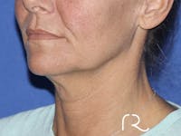 Neck Lift Before & After Gallery - Patient 121956053 - Image 1