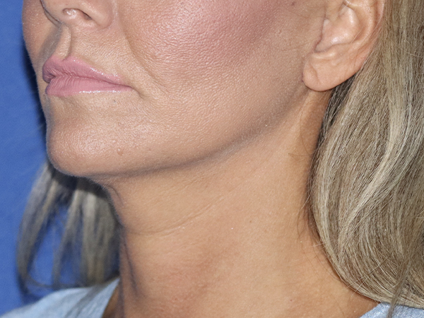 Facelift Before & After Gallery - Patient 121956021 - Image 2