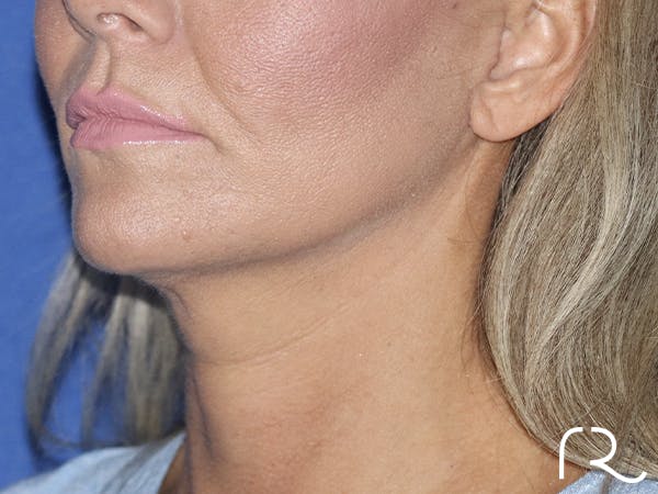 Neck Lift Before & After Gallery - Patient 121956053 - Image 2
