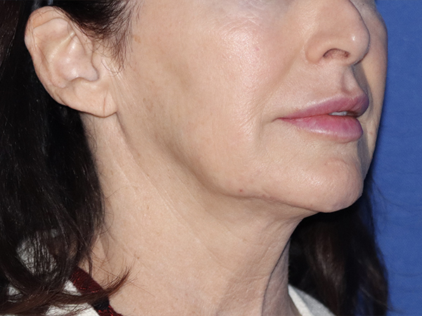 Neck Lift Before & After Gallery - Patient 121956054 - Image 1