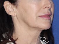 Facelift Before & After Gallery - Patient 121956022 - Image 1